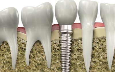 Six Reasons That Dental Implants Set the Gold Standard