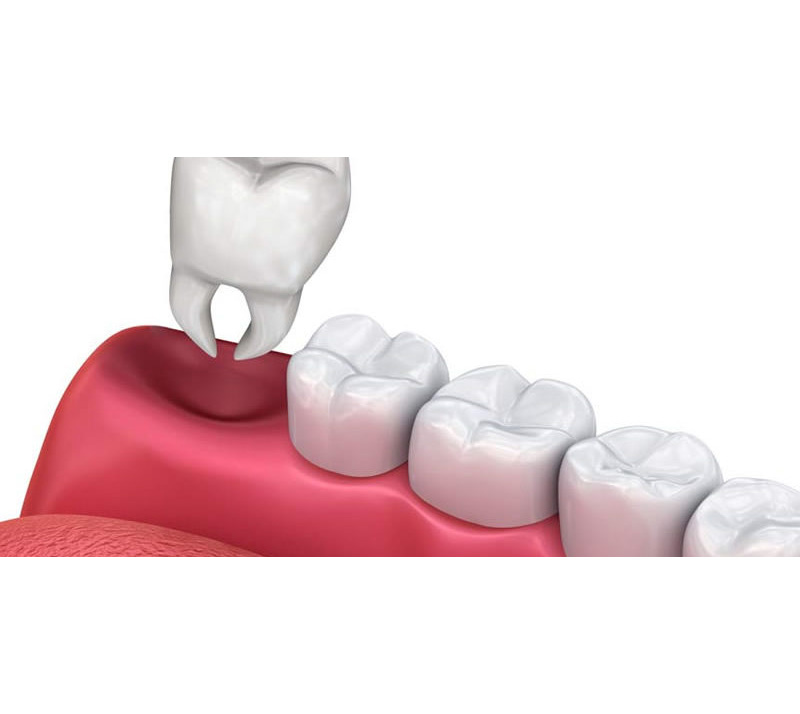 tooth extractions in kelowna tooth extractions in kelowna