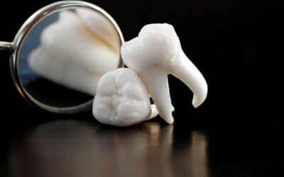 Commonly Asked Questions About CEREC Dental Crowns