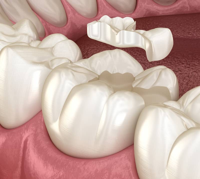 dental filling process structure wth tooth decay