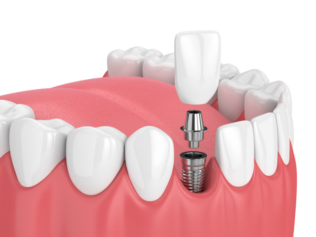 dental implant with teeth fitting process