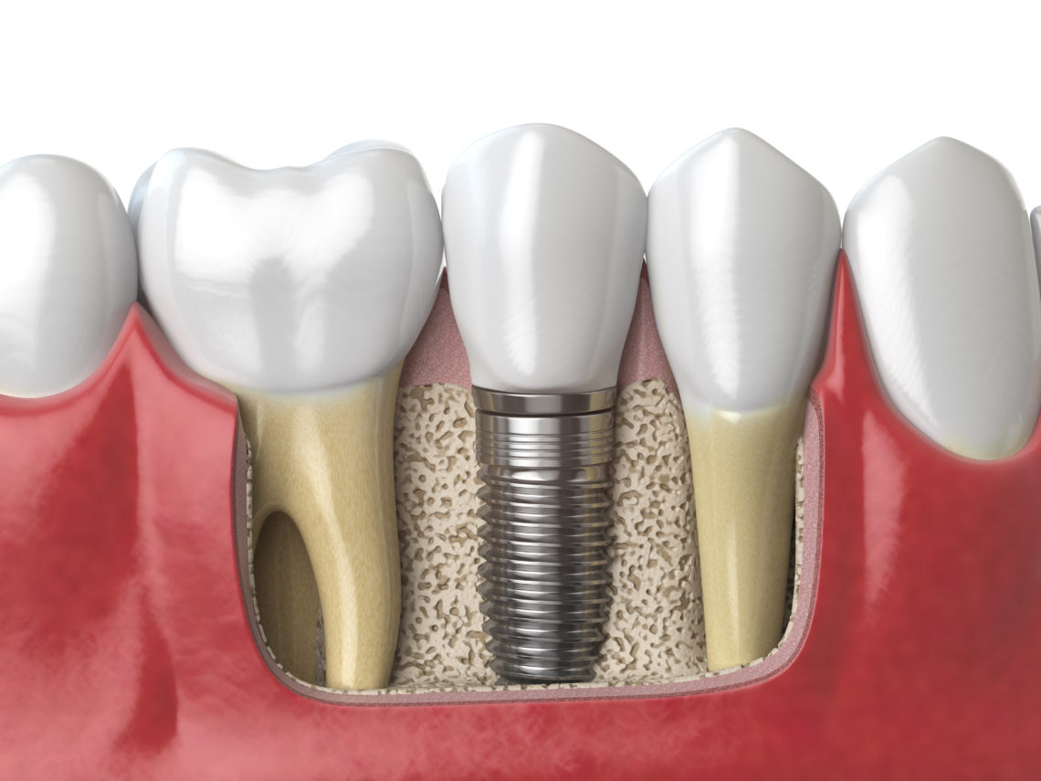 implanted teeth structure