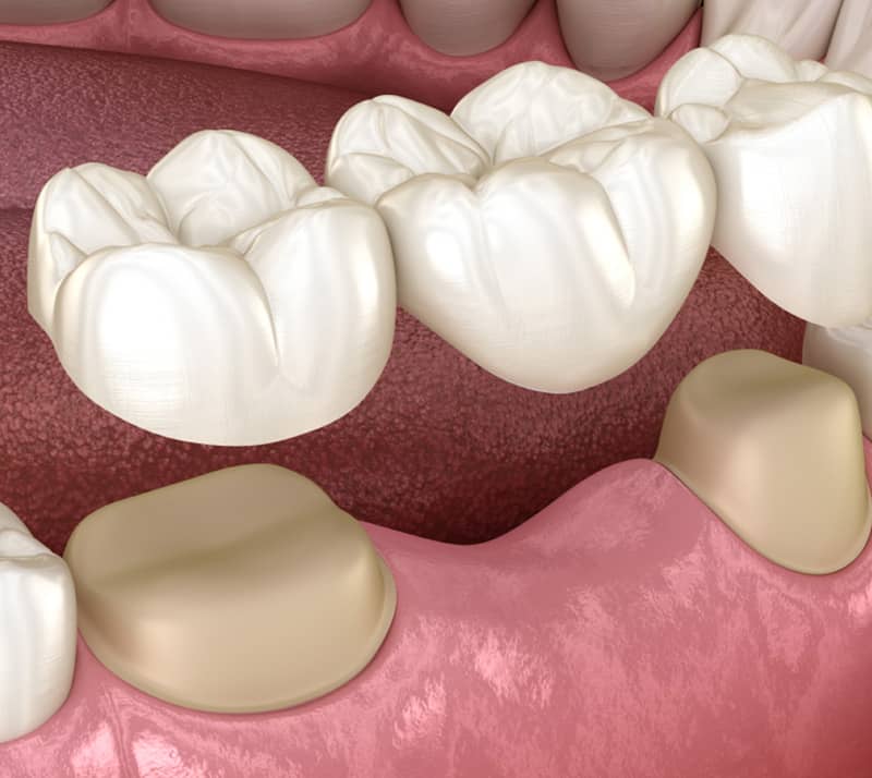 structure of dental bridges with gaps between teeth