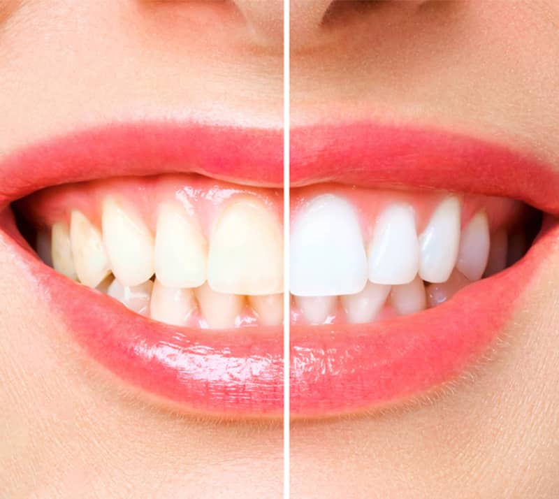 teeth before and after whitening